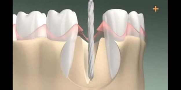 Diş implantı nasıl yapılıyor?