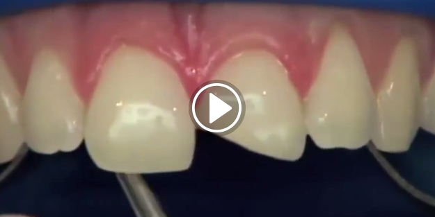 Diş kırığının çözümü bu kadar basit!