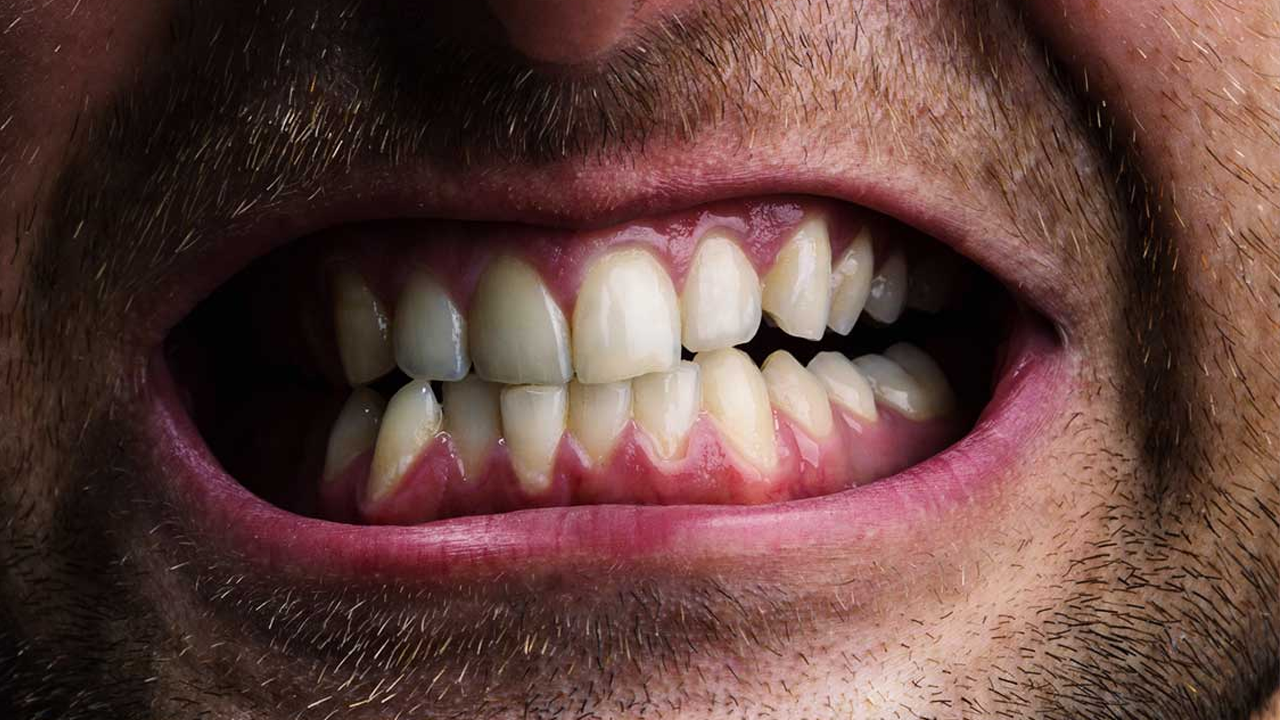 Diş sıkmanın yol açtığı sorunlara dikkat!