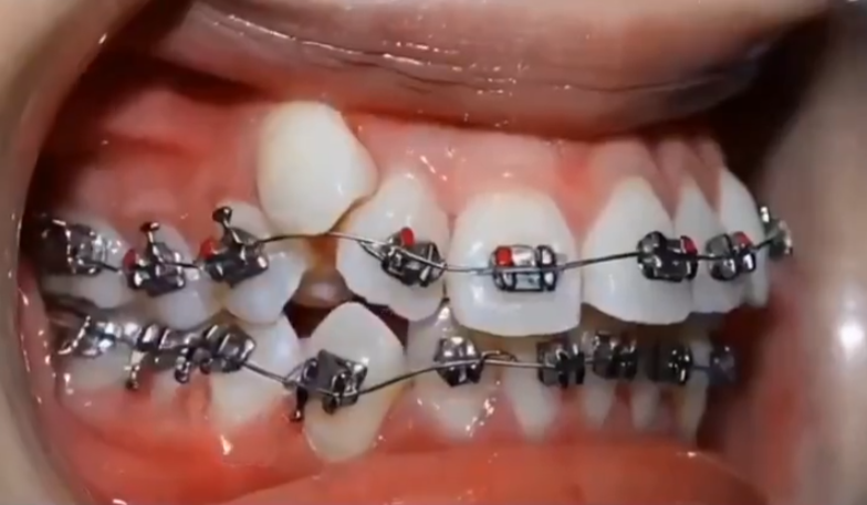 Diş teli bakın ne işe yarıyor! Sosyal medyada paylaşım ilgi topladı