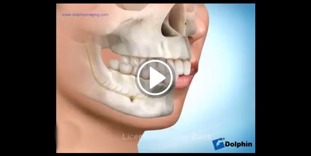 Diş teli tam olarak ne yapar?