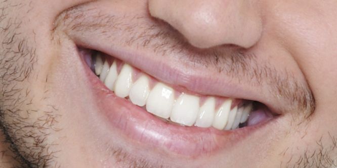 Dişlerde oluşan problemlere dikkat