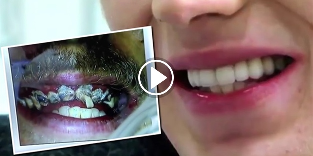 Dişlerini hiç fırçalamayan gencin inanılmaz değişimi