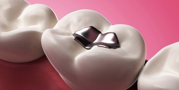 Dişlerinize cıvalı dolgu yaptırmayın