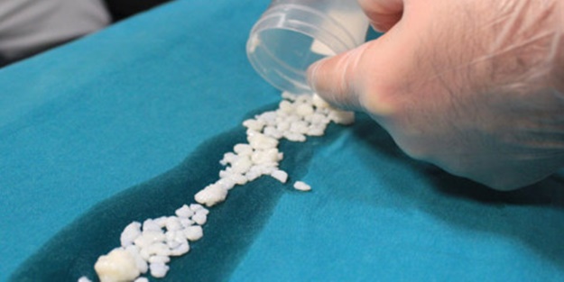 Dizlerinden 967 tane eklem faresi çıktı!