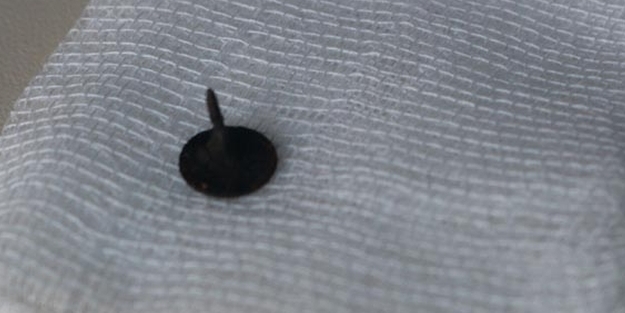 Doktorlar bile şaşırdı... akciğerinden çıktı!