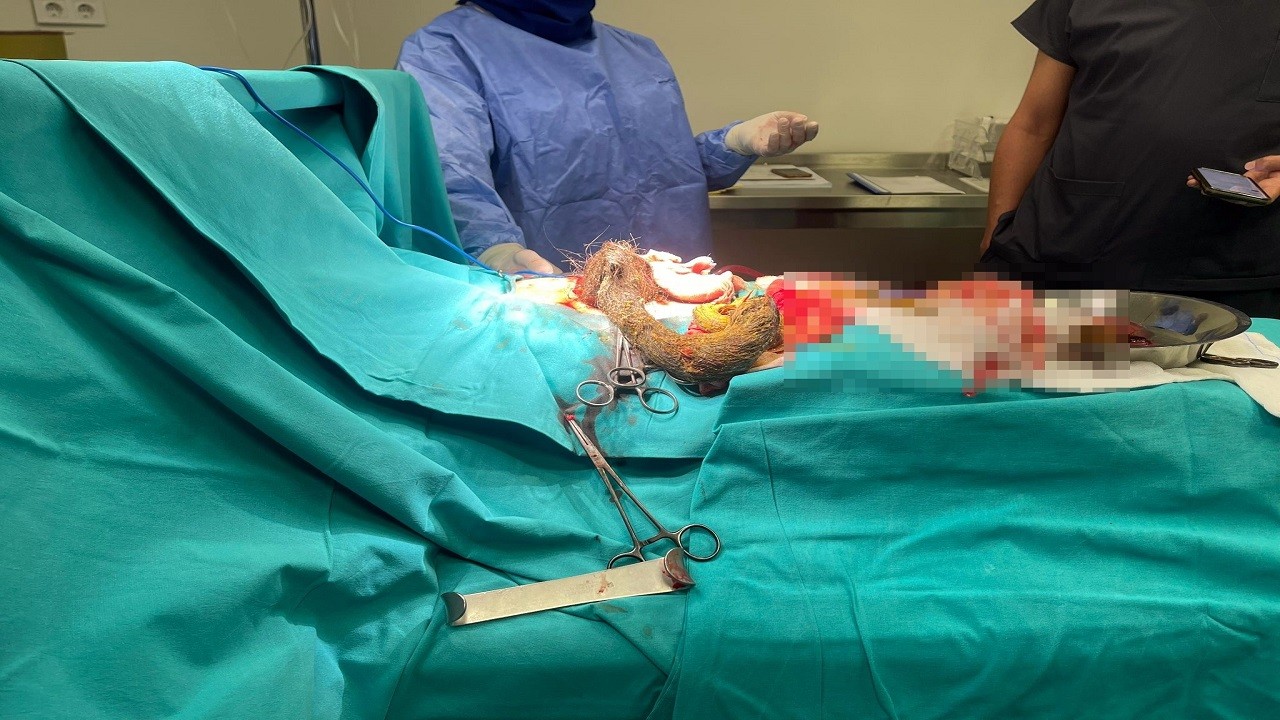 Doktorlar bile şaşırdı kaldı! 14 yaşındaki kızın midesinden öyle bir şey çıktı ki!
