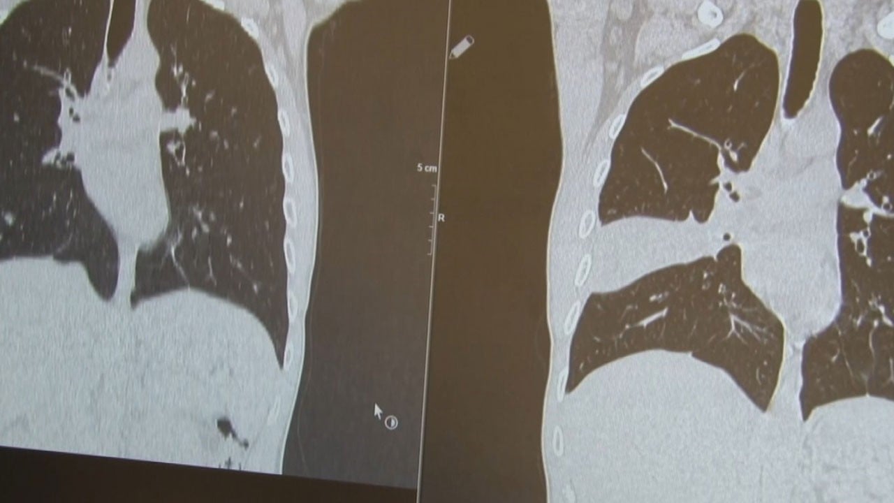 Doktorlar bile şaşırdı kaldı! Akciğerindeki şüpheli lezyonun sırrı ameliyatta çözüldü