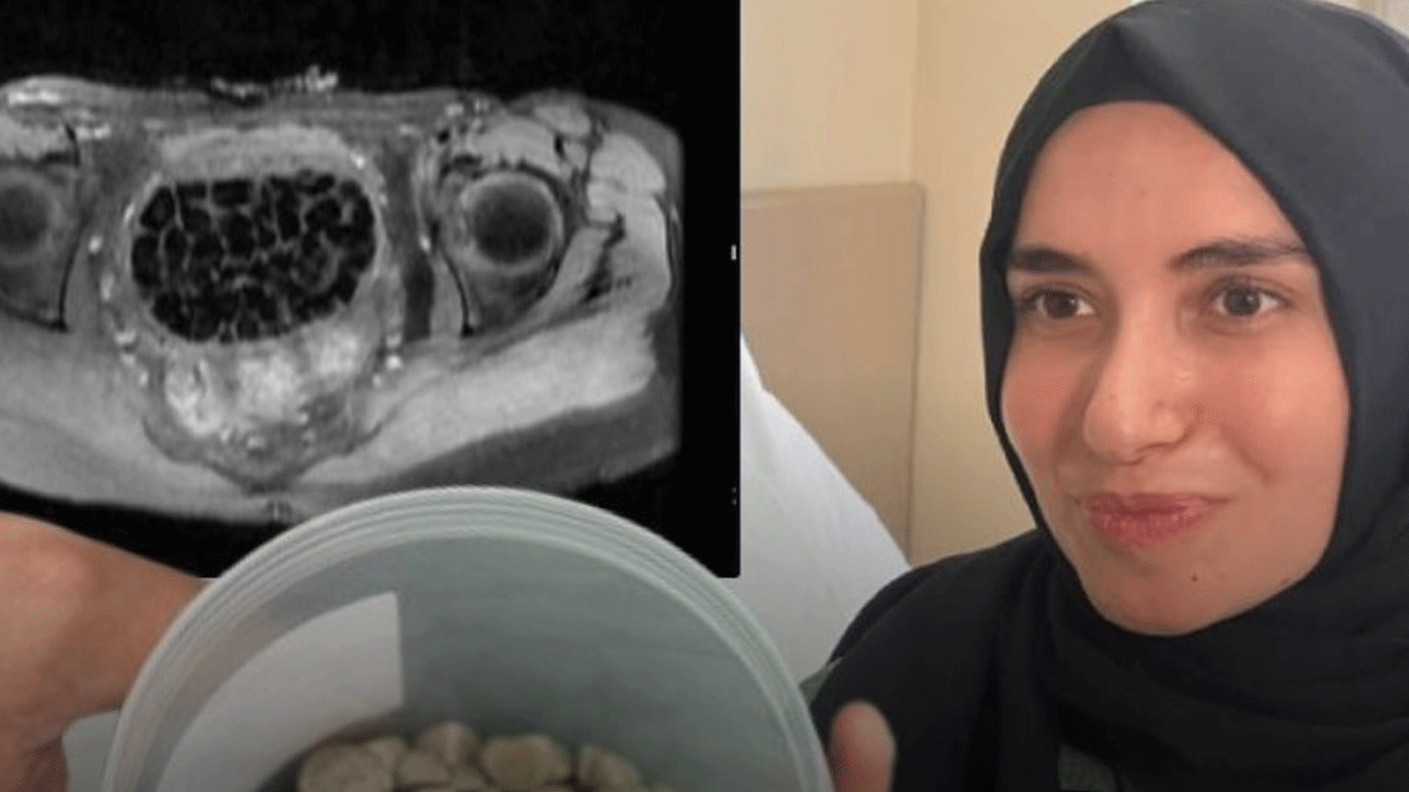 Doktorlar bile şok oldu: Vücudundan 287 tane taş çıkartıldı!