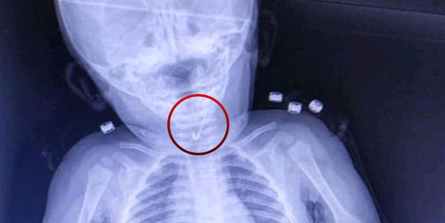 Doktorlar çengelli iğne yutan 7 aylık bebek için seferber oldu