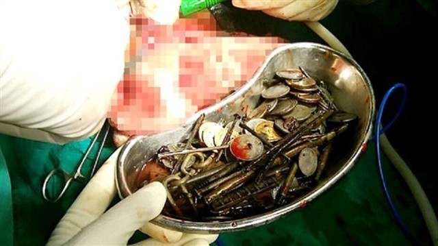 Midesinden çıkanlara inanamayacaksınız