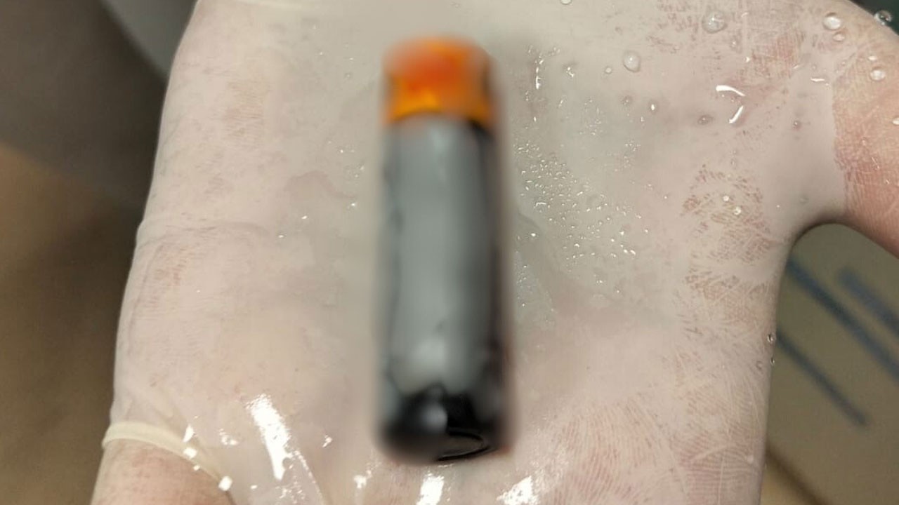 Doktorlar şaşkına döndü! Bu kez bir çocuk değil yetişkinin midesinden çıktı