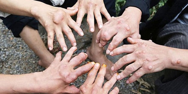 Doktorların bile teşhis koyamadığı hastalığa yakalandılar!