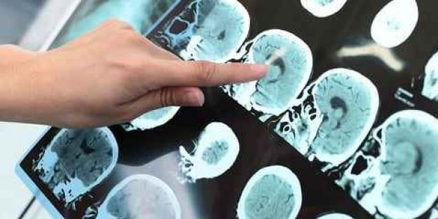 Doktorların dediği: Beyin tümörleri artık çok daha kolay tespit eden bu keşif oluyor! Bakın ne oldu