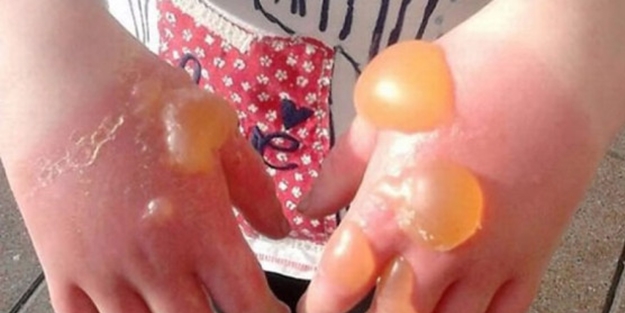 Dokunduğu çiçek elini bu hale getirdi!