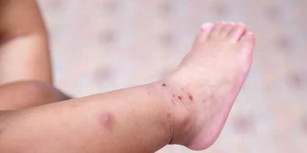 Domates gribi nedir, domates gribi belirtileri nelerdir? El ayak hastalığıyla karıştırılıyor!