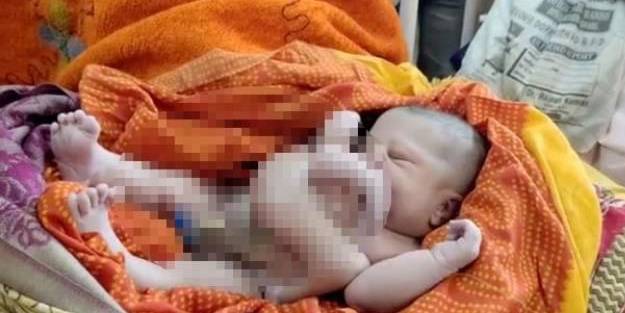 Dört kollu ve dört bacaklı bebek şaşırttı