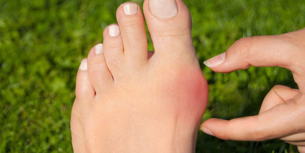 Ayak başparmağındaki eğrilik: Bu 5 belirtiye dikkat! Kadınlarda 10 kat daha fazla...