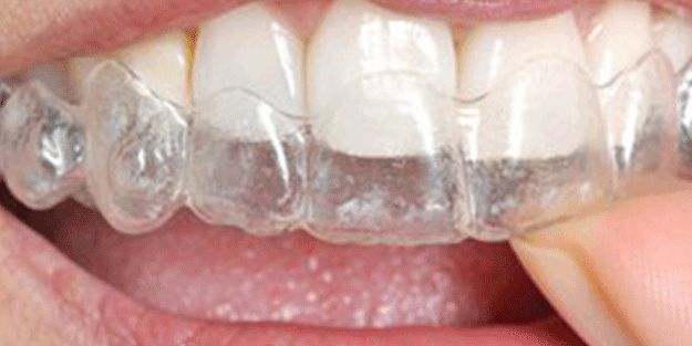 Diş sıkıp gıcırdatanlar dikkat! Uzman isim açıkladı: Eğer yapılmadığı takdirde…