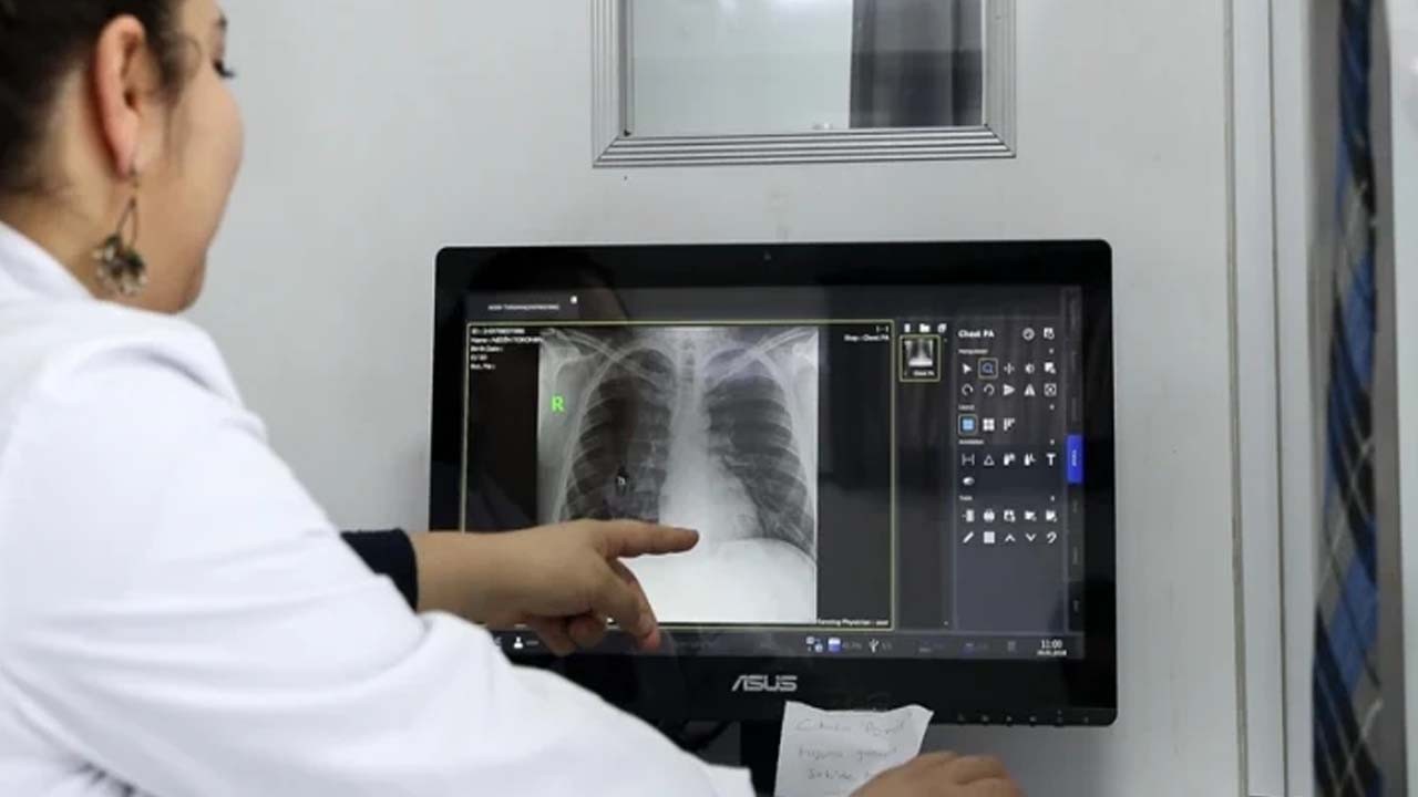 DSÖ: 2023’te tam 8,2 milyon kişi verem oldu! Bakın nerde!