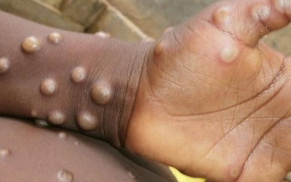 DSÖ maymun çiçeği vaka sayısını açıkladı