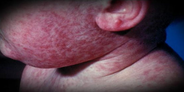 DSÖ'den kritik uyarı: Kızamık yeniden salgın hale gelebilir