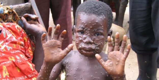 DSÖ'den maymun çiçeği açıklaması! Afrika'da bu yıl...