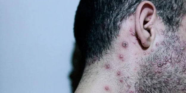 DSÖ’den maymun çiçeği salgını ile ilgili uyarısı! Endişe veriyor