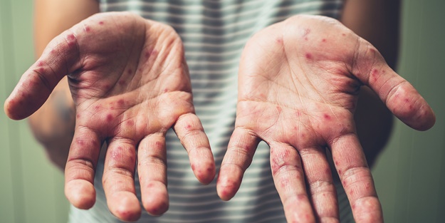 DSÖ'den uyarı: Vakalar yayıldı