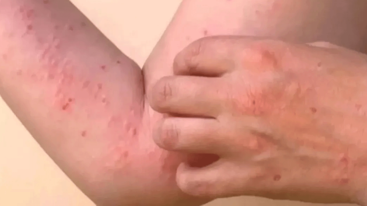 DSÖ'den virüs uyarısı: Belirtileri ağır ama ölümcül değil!