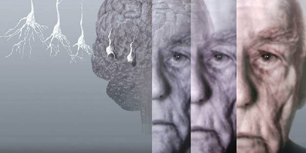 DSÖ'ye göre alzaymır, ölüme yol açıyor