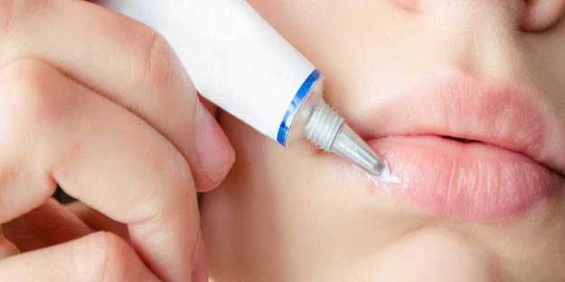 Dudak uçuğu nasıl geçer?