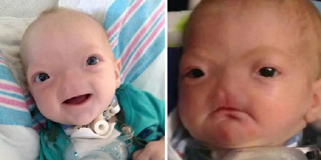 Dünya onu konuşuyordu! Burunsuz doğan bebek büyüdü: İşte son hali...