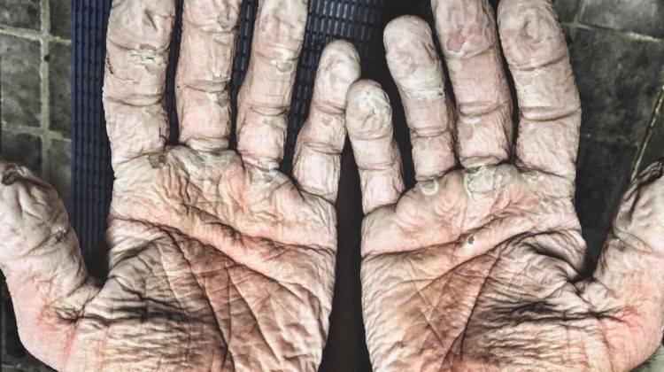 Dünya rekoru kırdı ama elleri bu hale geldi!