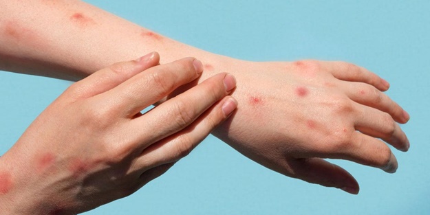 Dünya Sağlık Örgütü'nden maymun çiçeği açıklaması