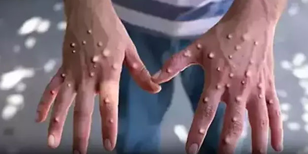 Dünya Sağlık Örgütü'nden Maymun Çiçeği açıklaması! 'Stratejik Hazırlık ve Müdahale Planı' geliştirildi