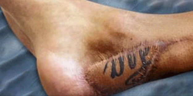 Dünyaca ünlü futbolcunun ayağı kangren oldu ve...