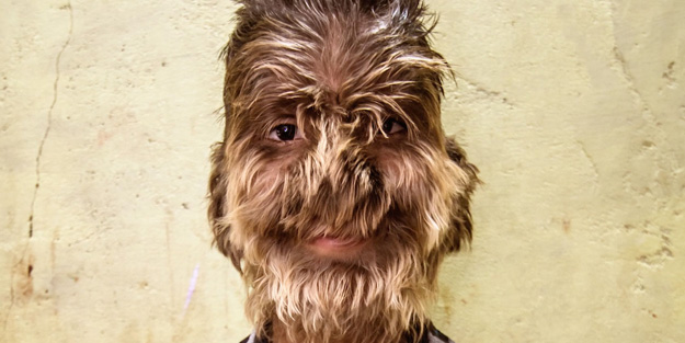 Dünyada görülen nadir ve garip 10 hastalık...