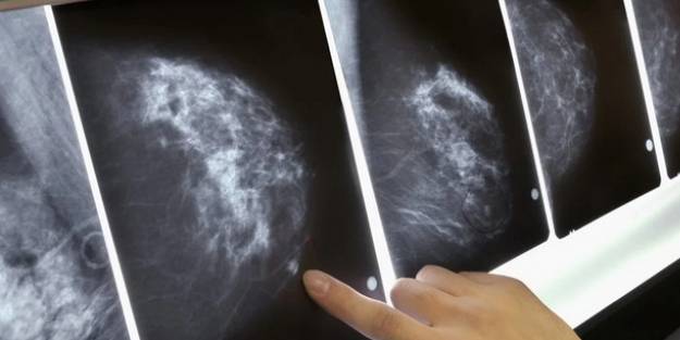 Dünyada her 5 kişiden biri kansere yakalanıyor