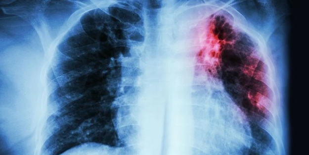 Dünyada her yıl 10 milyon kişi bu hastalığa yakalanıyor