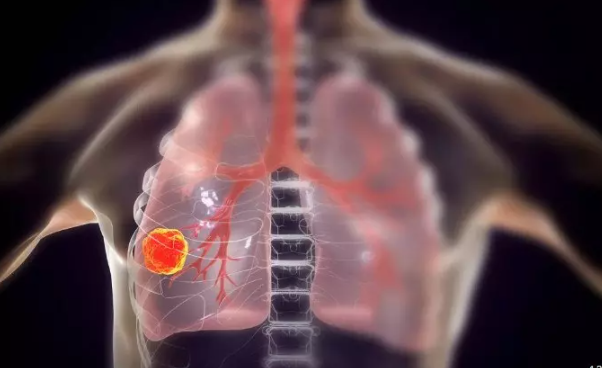 Dünyada ilk! Akciğer kanseri tarih oluyor