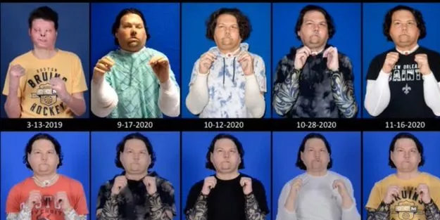 Dünyada ilk kez! Eş zamanlı çift el ve yüz nakli oldu: Tuhaf bakıyorlar