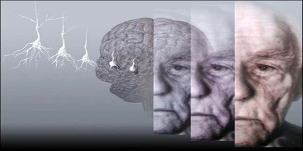 Dünyada kayıtlı 35 milyon alzheimer hastası var