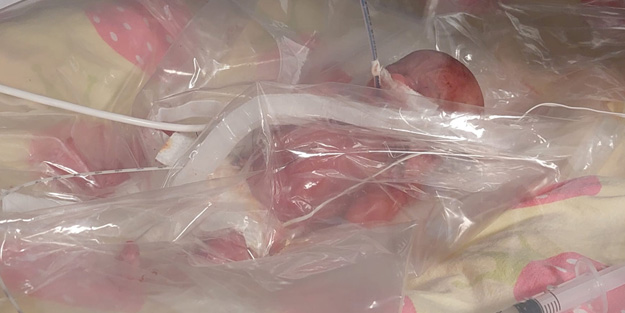 Dünyada nadir rastlanıyor! Türkiye'de 310 gramlık bebek doğdu