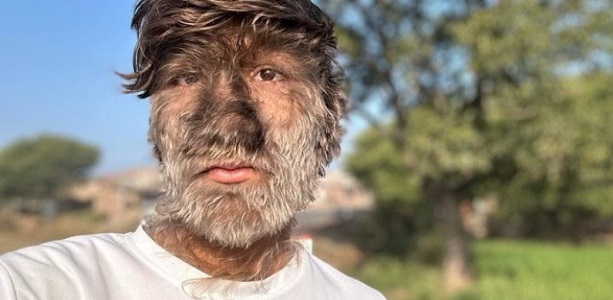 Dünyada sadece 50 kişide bu hastalık var! Kurt adamlar gerçek mi?