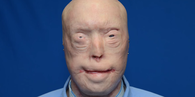 Dünyanın en başarılı yüz nakli gerçekleştirildi!