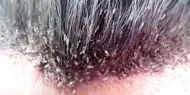 Dünyanın en bitli adamı - FOTO