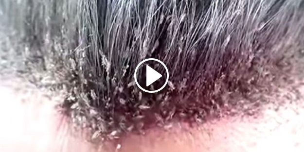 Dünyanın en bitli adamı böyle görüntülendi