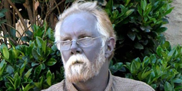 Dünyanın en ilginç hastalıkları - FOTO