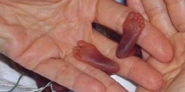 Dünyanın en küçük bebeği büyüdü! - FOTO